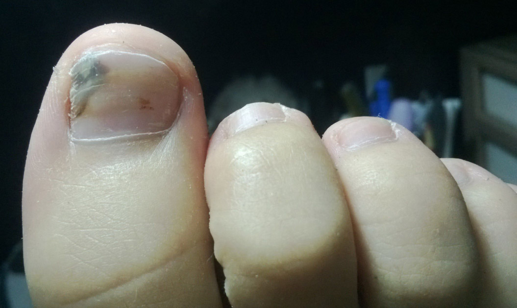 灰指甲病理知识