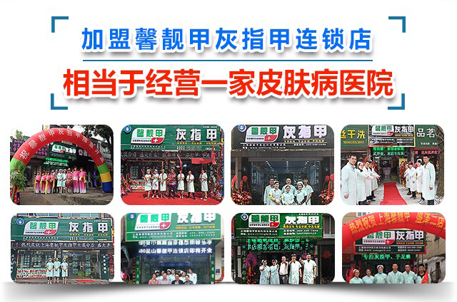 18.馨靓甲·灰指甲产品效果怎么样？灰指甲代理