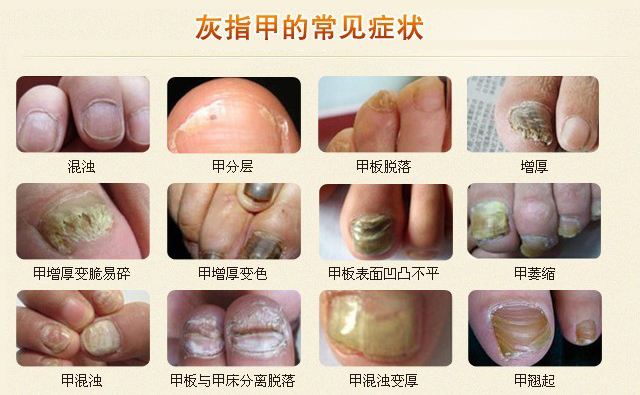 刚得灰指甲有哪些症状？